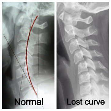 Difference between a normal spine and a cervical spine that has lost its curve.